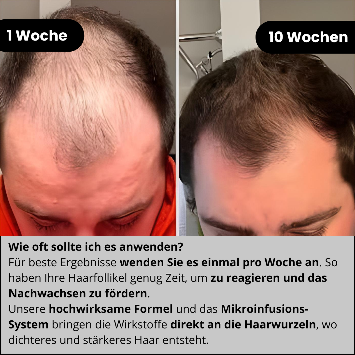 Peak Infuse Micro-Infusion Haarwuchs-System